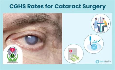 cghjn|List of CGHS Rate for Cataract Surgery in India .